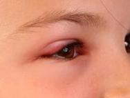 Η εμφάνιση του στελέχους στο μάτι και πώς να το θεραπεύσετε σε μια μέρα