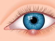 نحوه درمان سریع جو روی چشم: علائم، علل و روش های درمان