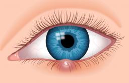 Como curar rapidamente a cevada no olho: sinais, causas e métodos de tratamento